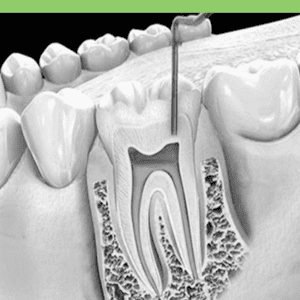 Root Canal