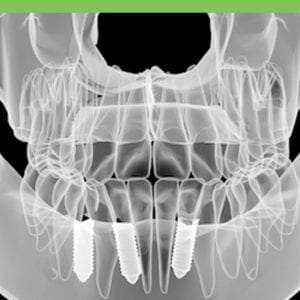 Computer Guided Implant Surgery