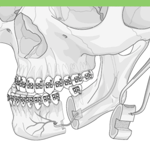 Mandibular osteotomy