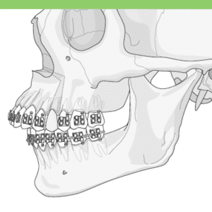 Maxillary osteotomy