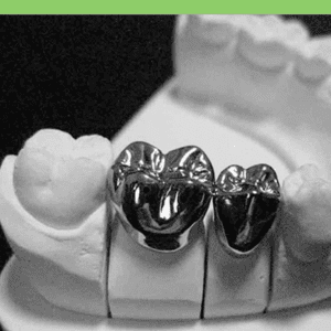 Base metal alloy crowns