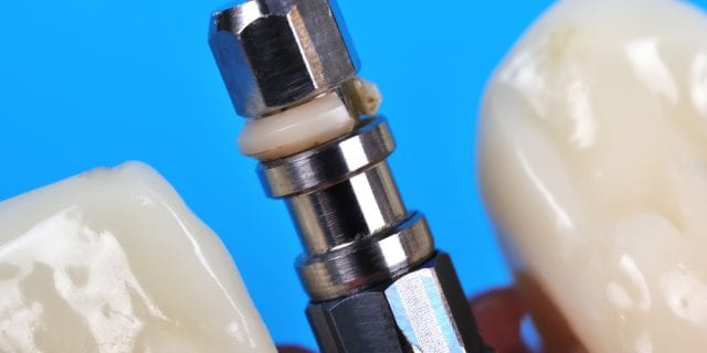 How Much Are Dental Implants in Costa Rica?