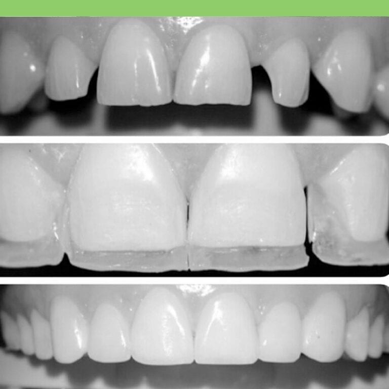 Composite Bonding / Teeth Bonding Costa Rica Dental Guide to Best