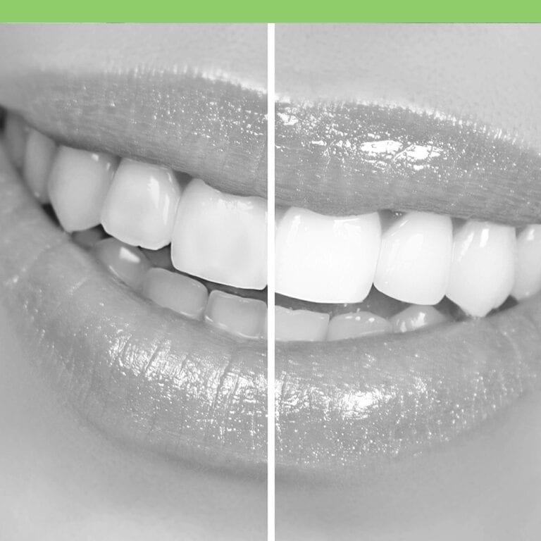 Teeth Whitening Costa Rica Dental Guide to Best Dentists