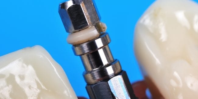 Dental Implants in Costa Rica – Let’s Talk Numbers